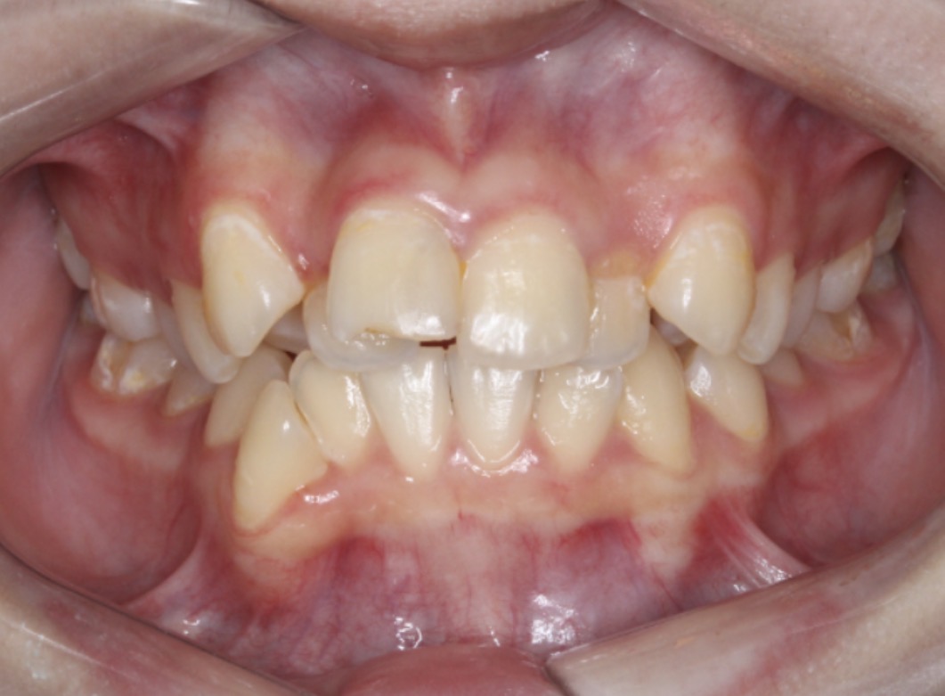 Foto intraoral antes do tratamento com Invisalign