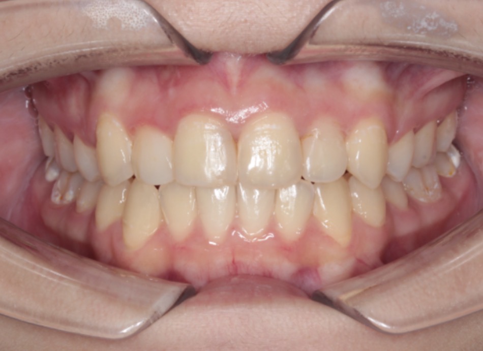 Foto intraoral após o tratamento com Invisalign